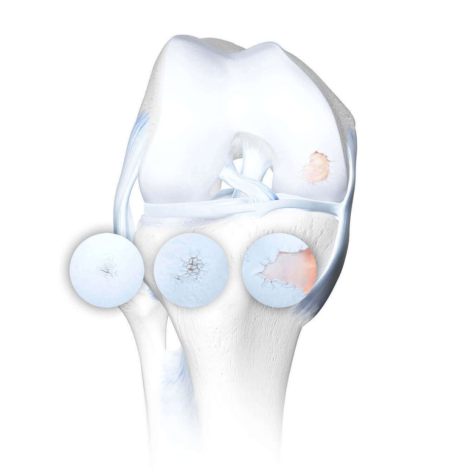 Grafische Darstellung eines Kniegelenks mit Arthrose, in vier Stadien fortschreitender Knorpelschädigung