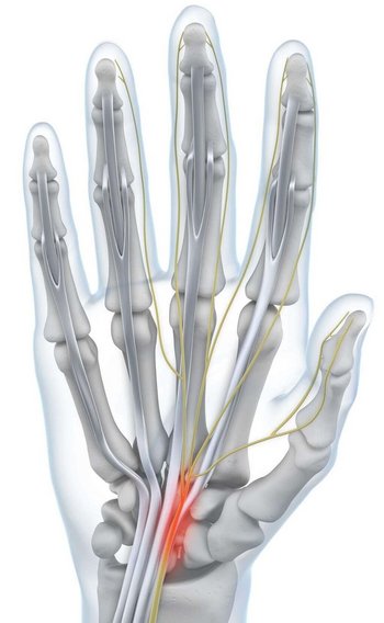 Darstellung der Anatomie der Hand bei einem vorliegenden Karpaltunnelsyndrom.