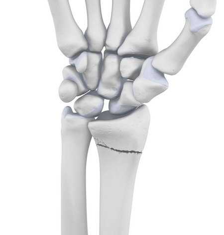 Darstellung der Anatomie der Hand mit einer vorliegenden Radiusfraktur.
