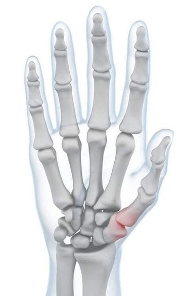 Illustration der Anatomie der Hand bei auftretenden Schmerzen im Daumengelenk