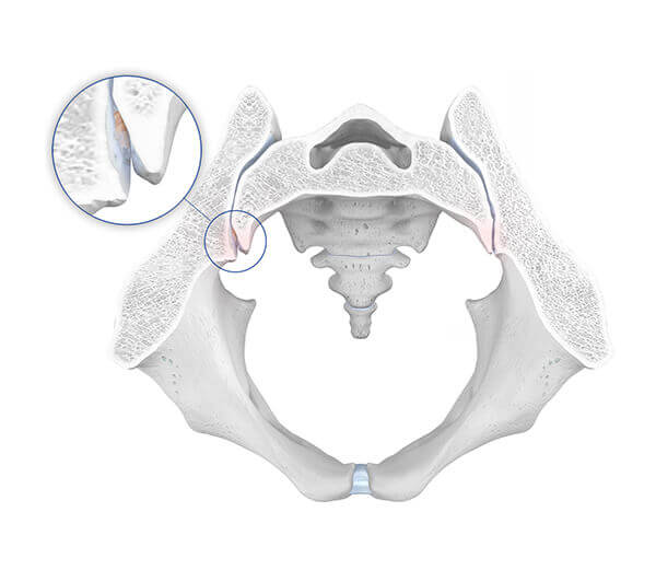 Illustration der Anatomie der Hüfte bei einer vorliegenden ISG-Arthrose.